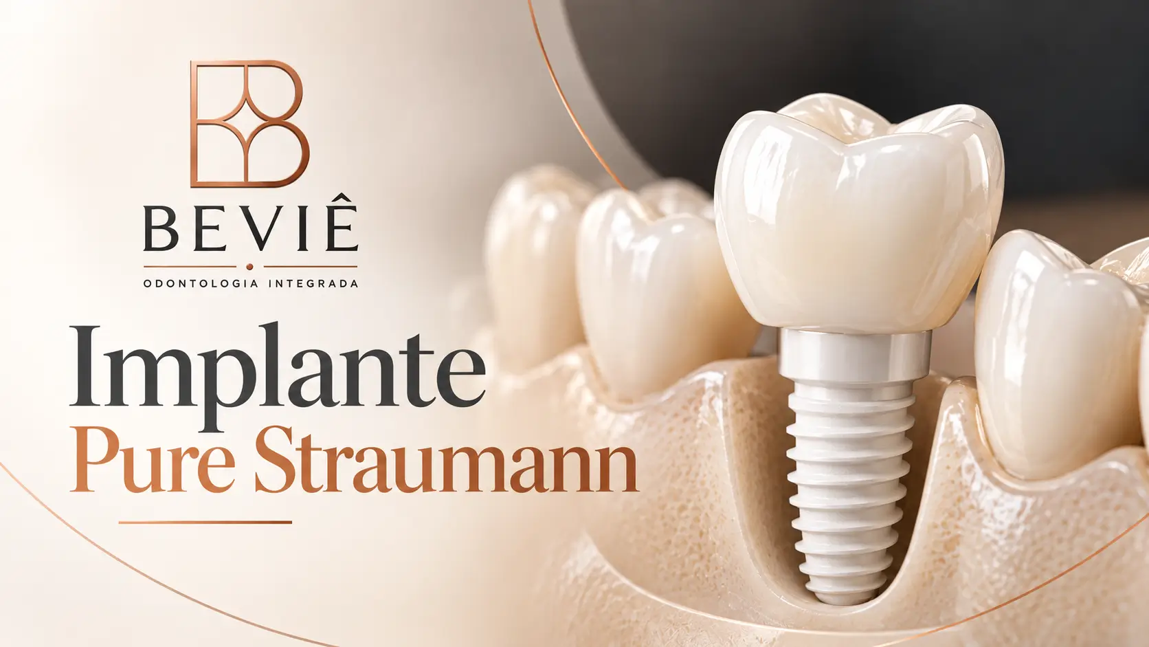 Implante Pure Straumann em Belo Horizonte na Beviê Odontologia, clínica odontológica em BH no bairro Santa Efigênia